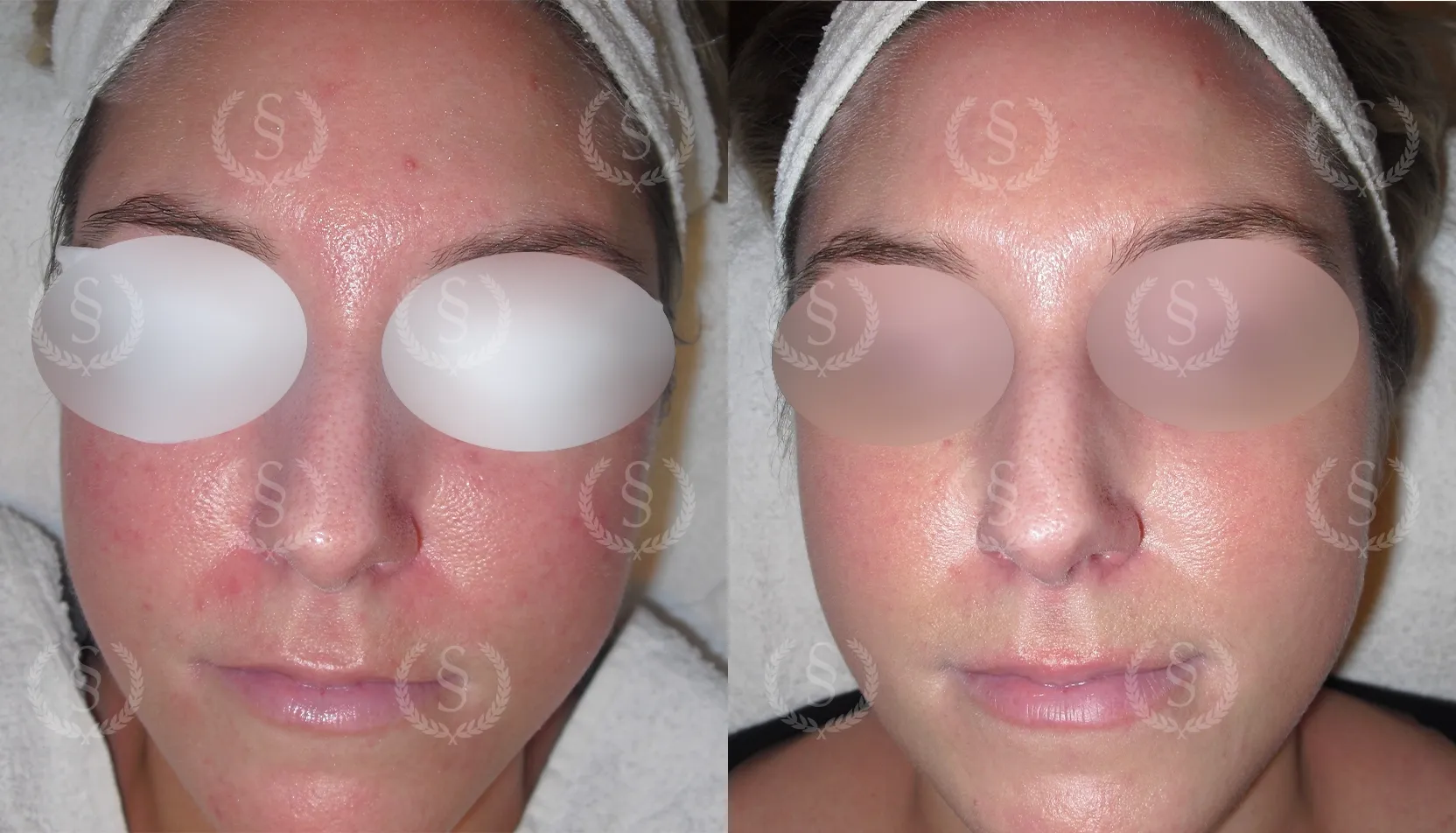 Resultat efter behandling av rosacea på näsvingar Rosacea på näsvingar före och efter behandling