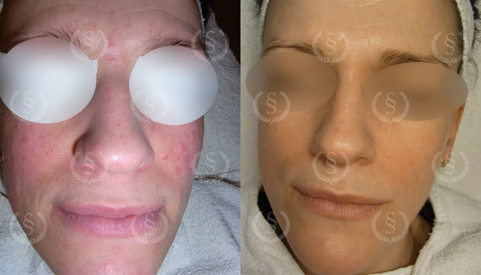 Resultat efter behandling av rosacea på panna och kinder Rosacea på panna och kinder före och efter behandling