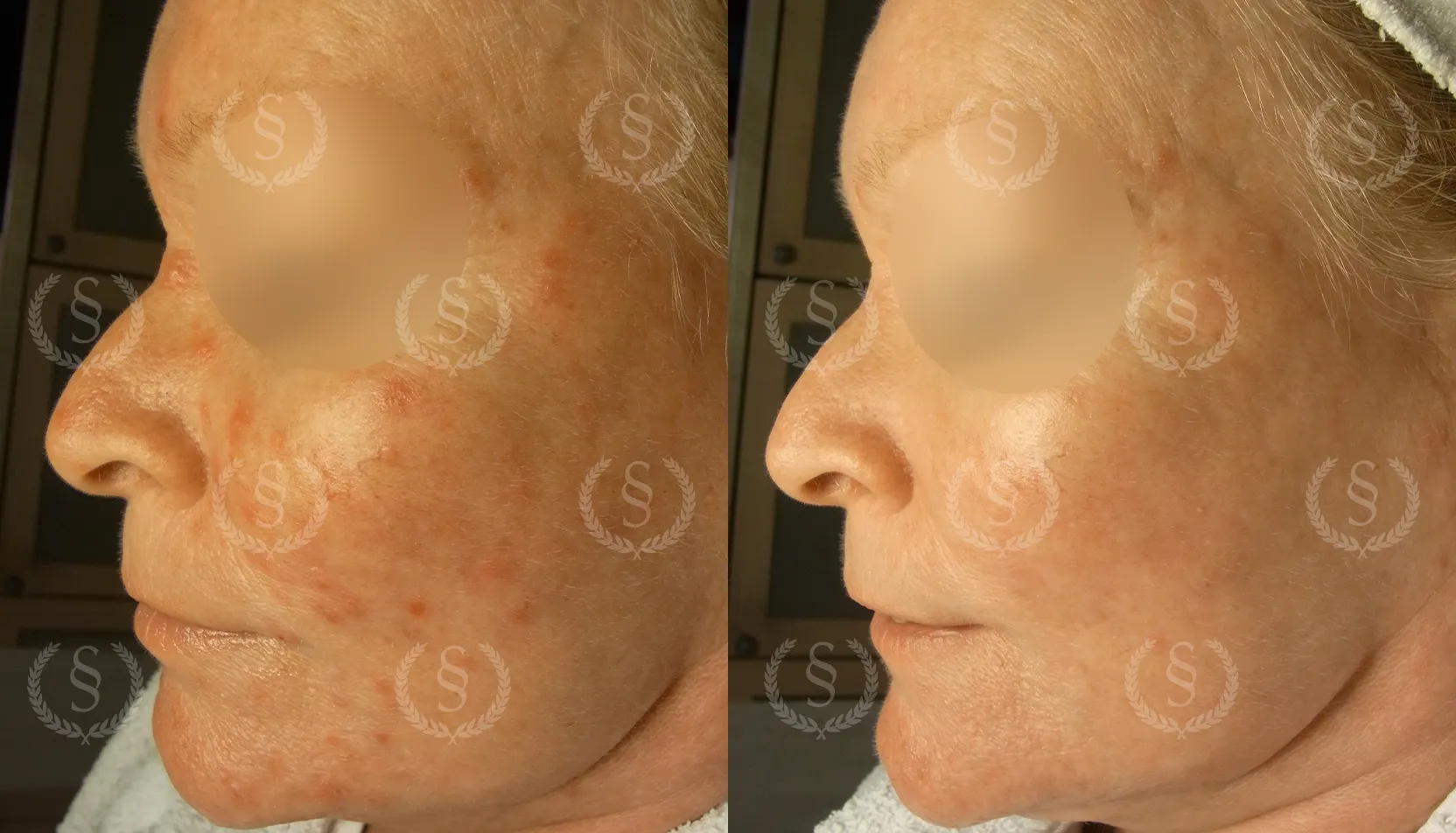 Behandling av rosacea med prickar Rosacea med prickar före och efter behandling