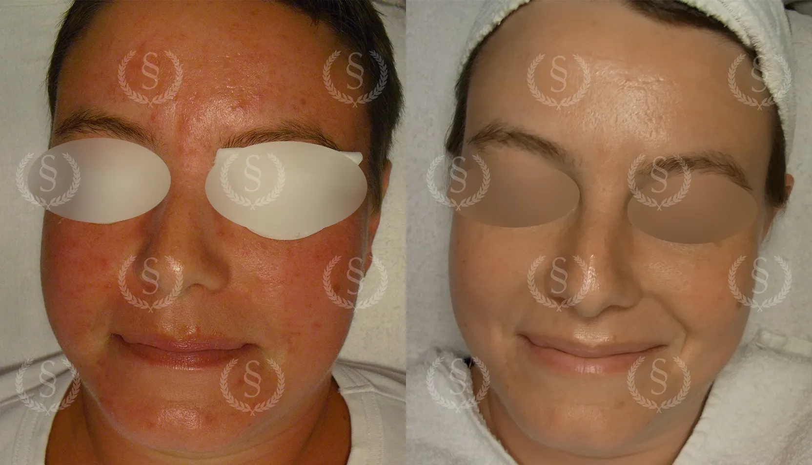 Resultat efter behandling av rosacea-rodnad Rodnad från rosacea före och efter behandling