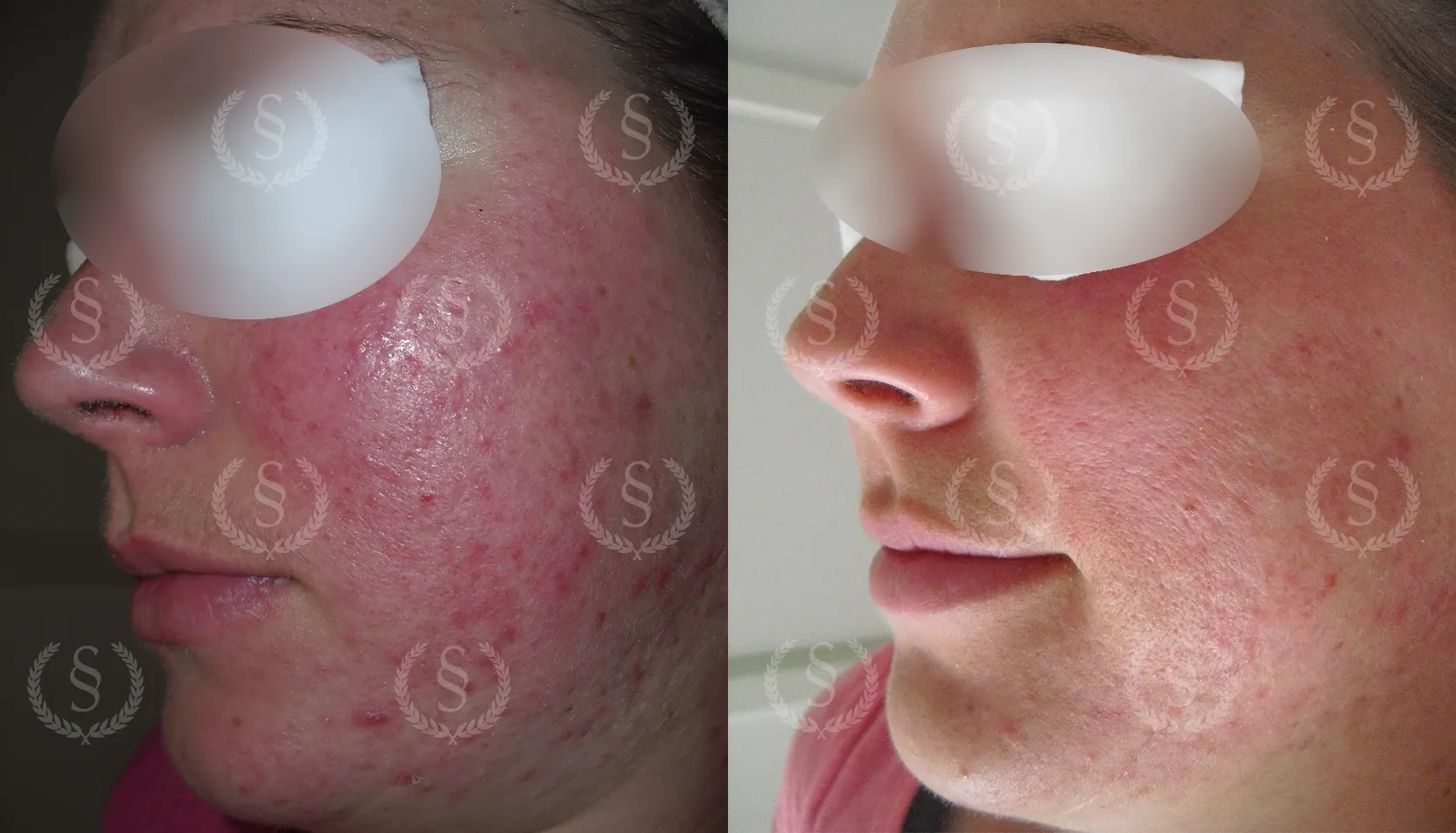 Resultat efter behandling av rött ansikte Rött ansikte från rosacea före och efter behandling