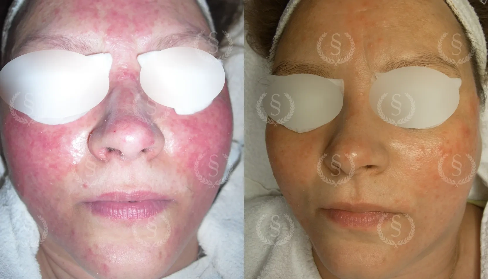 Behandling av svår rosacea Svår rosacea i ansiktet före och efter behandling