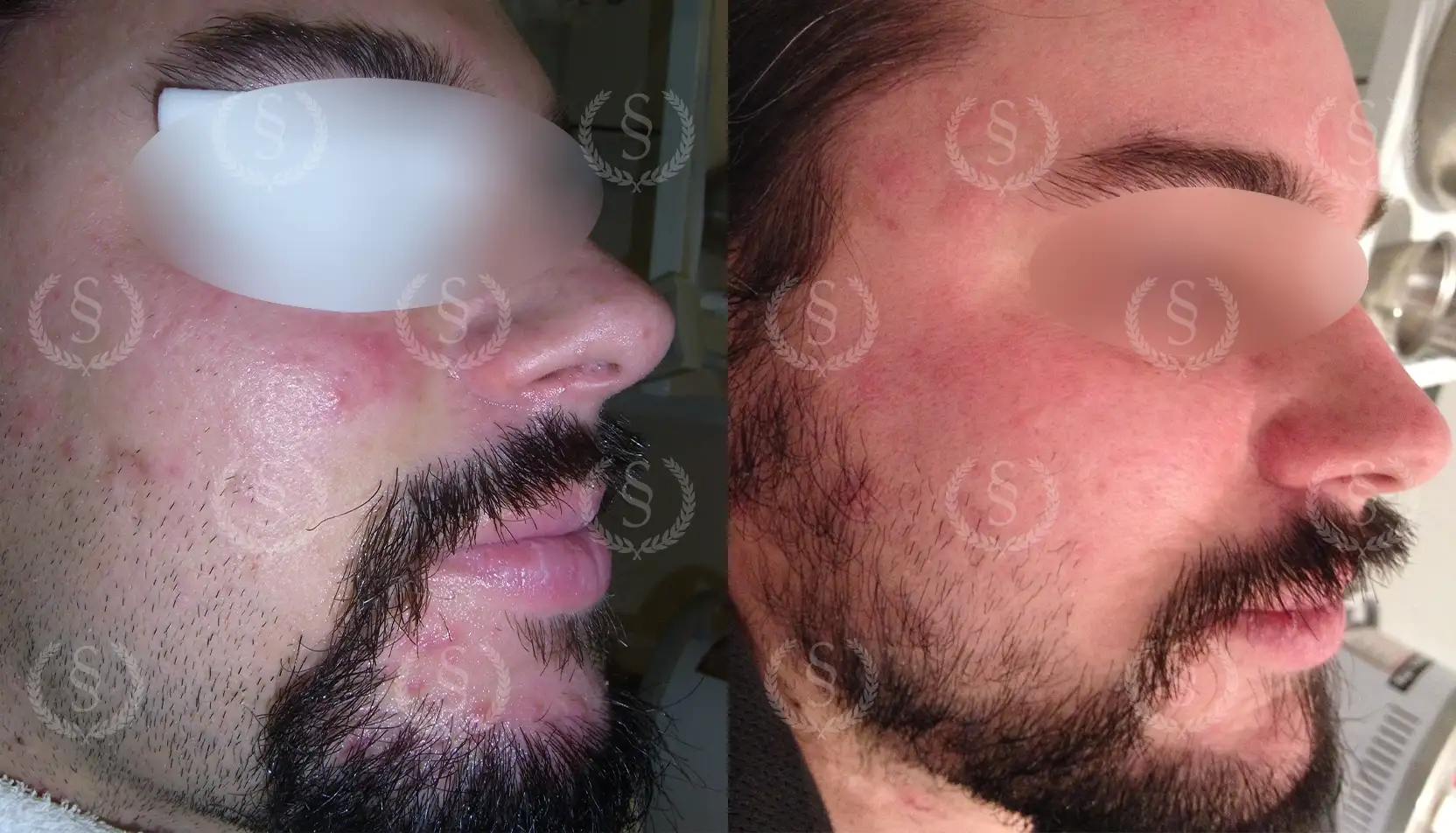 Resultat efter behandling av rosacea med utslag Rosacea med utslag före och efter behandling