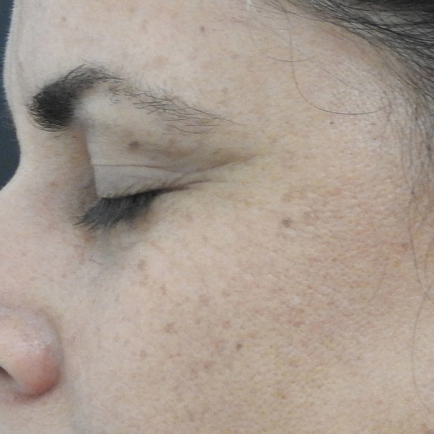 Efter SoftLift-behandling