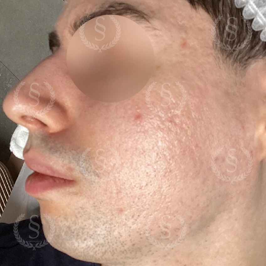 Efter laserbehandling Förbättrad hudstruktur efter laserbehandling