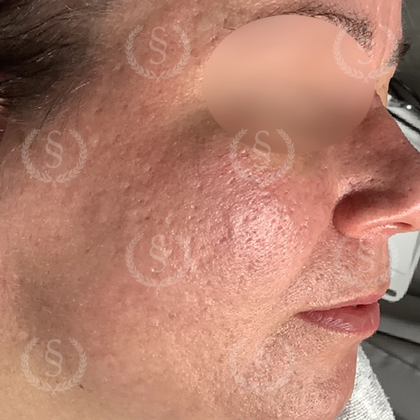 Efter laserbehandling Jämnare hudyta efter laserbehandling