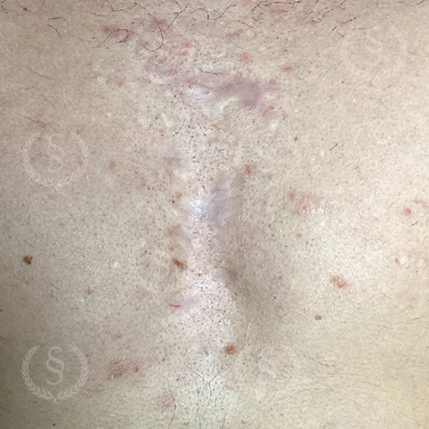 Efter laserbehandling Resultat efter laserbehandling