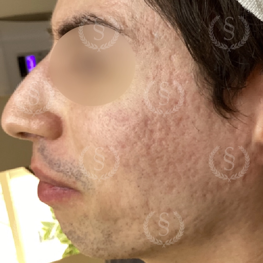 Före laserbehandling Acneärr i ansiktet före laserbehandling