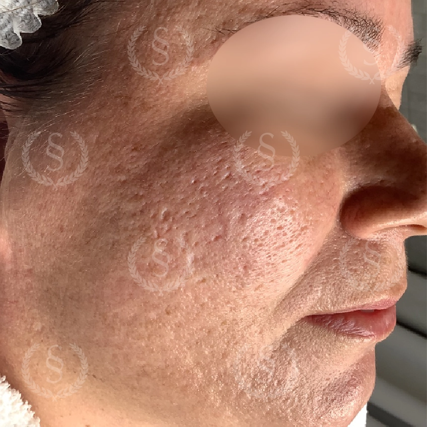 Före laserbehandling Djupa ärr i ansiktet före laserbehandling