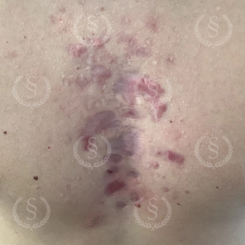 Före laserbehandling Ärr på bröstet före laserbehandling