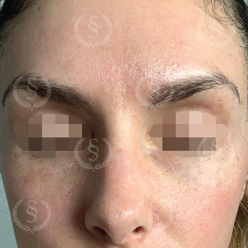 Efter pigmentfläckbehandling Resultat efter CO2-laser mot pigmentfläckar