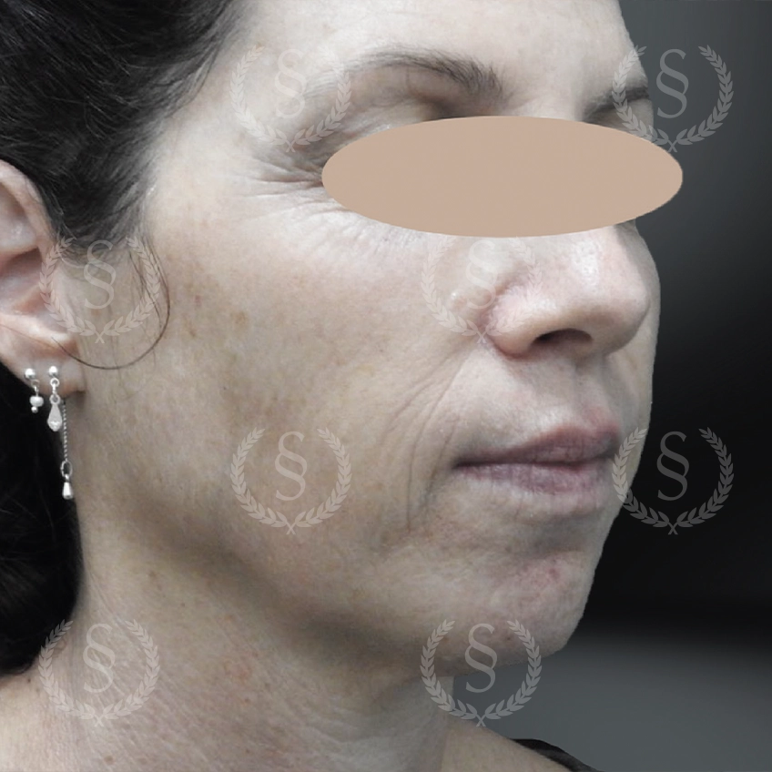 Före CO2-laserbehandling Pigmentfläckar och ojämn hudton före behandling