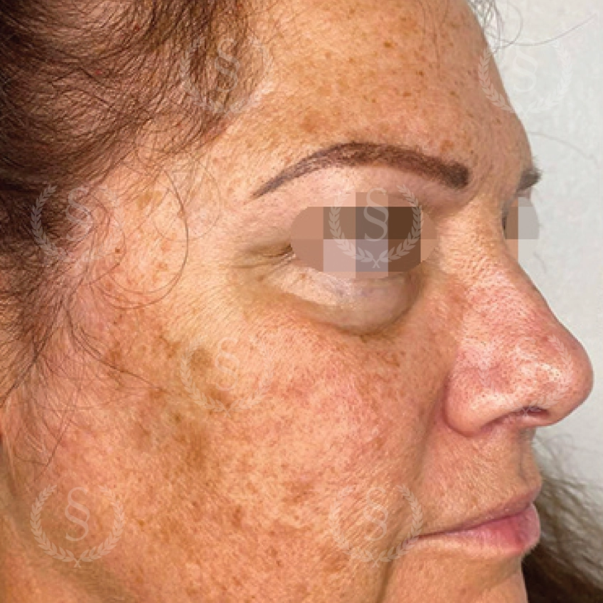 Före CO2-laser Pigmentfläckar på kinder före behandling