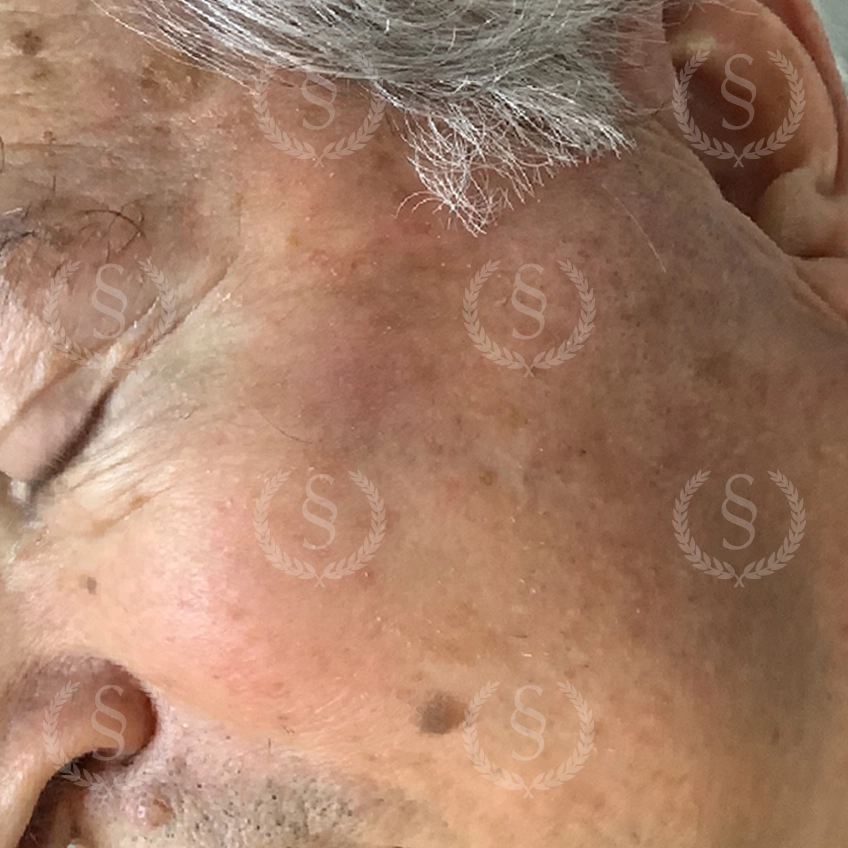 Resultat efter laser mot hudförändring